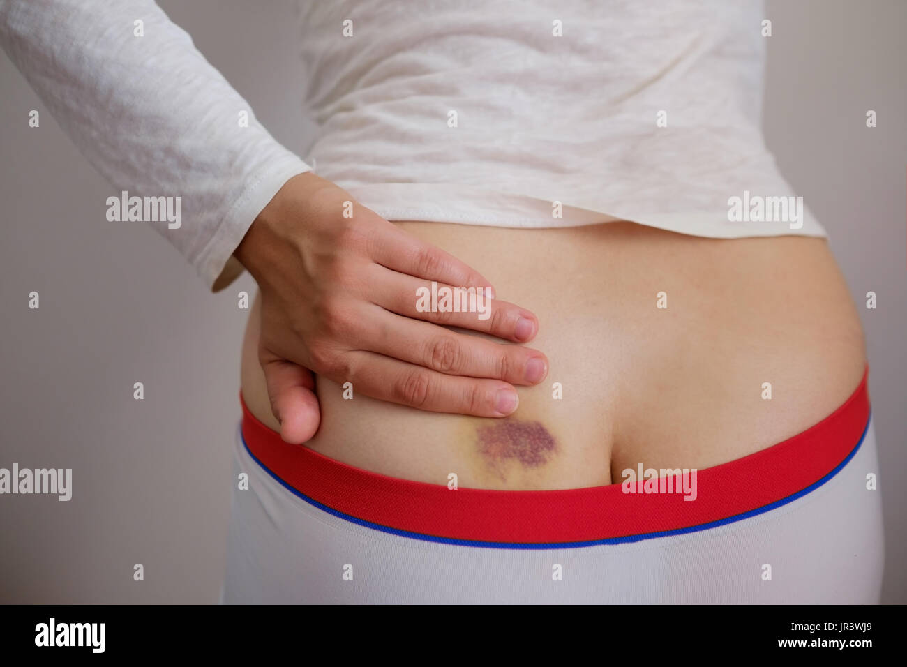 Bruise High Resolution Stock Photography and Images - Alamy Bruise High Resolution Stock Photography and Images - Alamy
