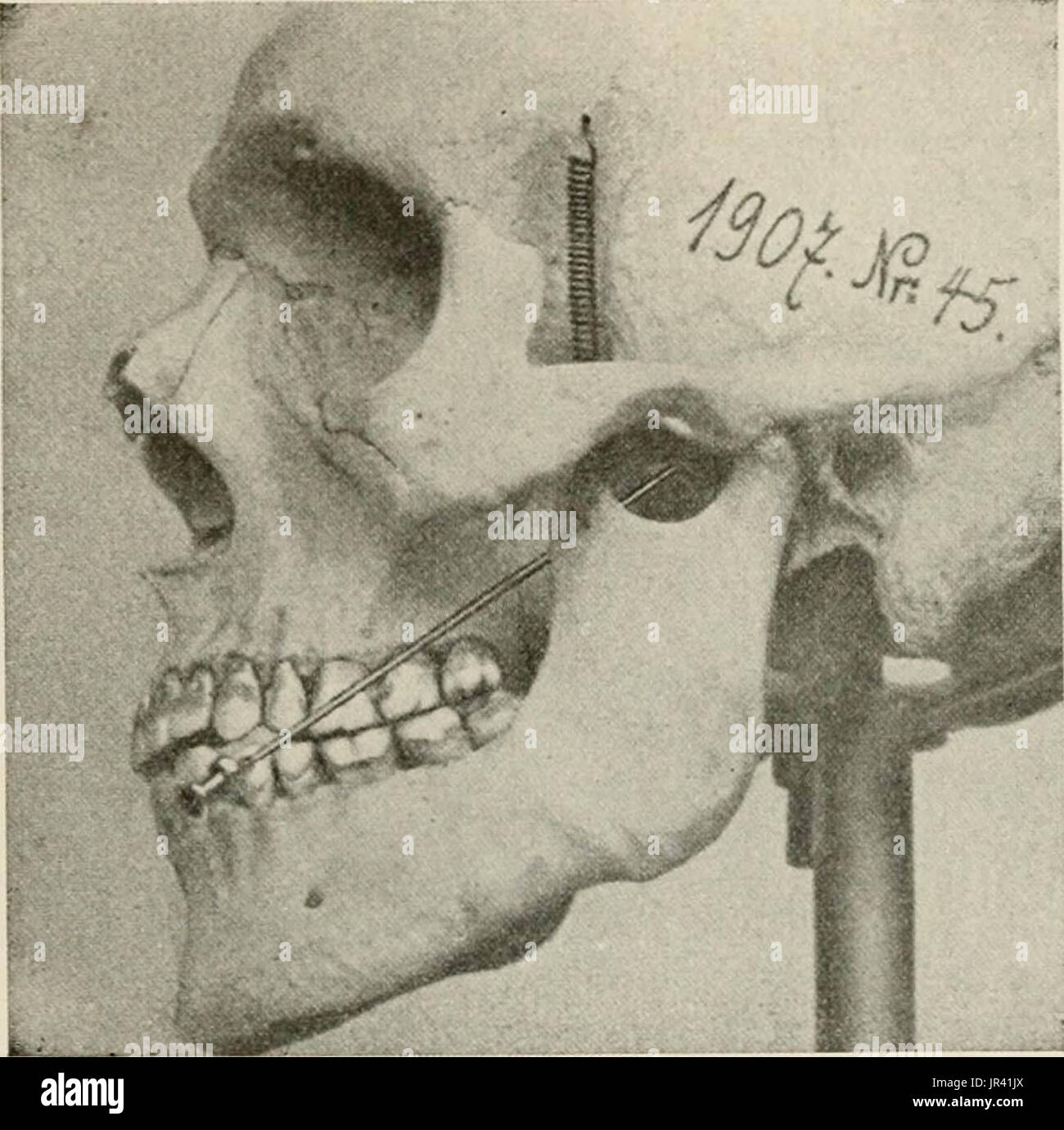 "Local and regional anesthesia; with chapters on spinal, epidural