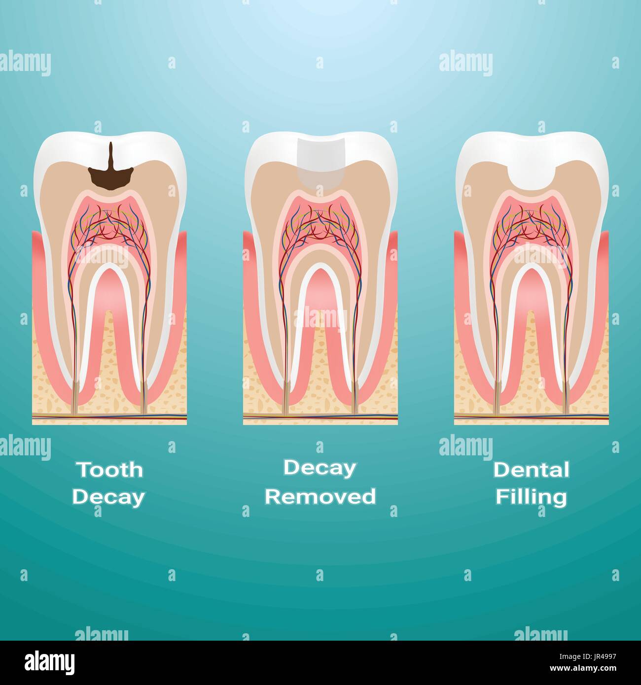 dental caries treatment