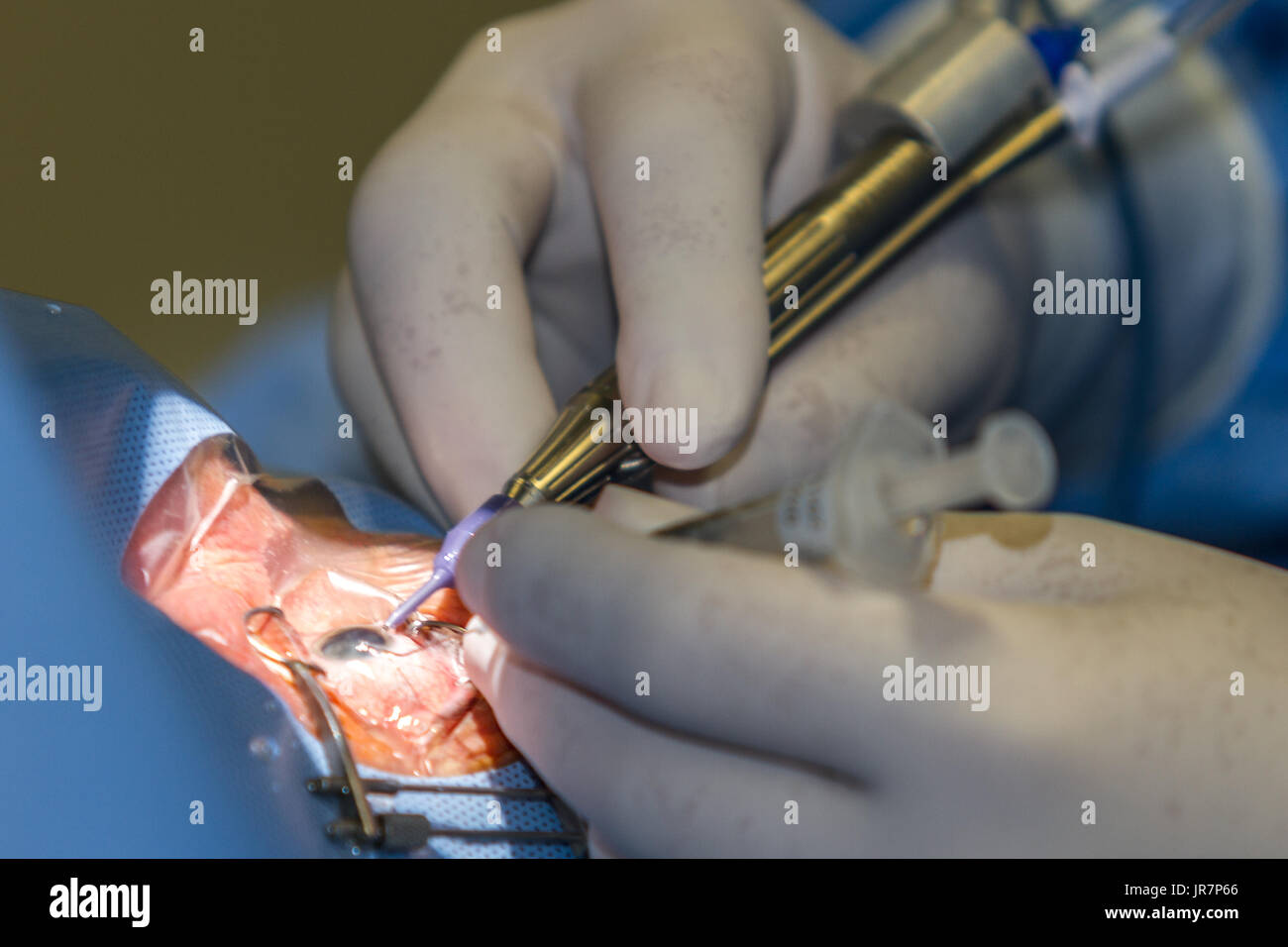 Zagreb, Croatia - June 12, 2017: Eye surgery in the hospital, eye and diopter correction. In the operation of the gray star, the torn lens is surgical Stock Photo