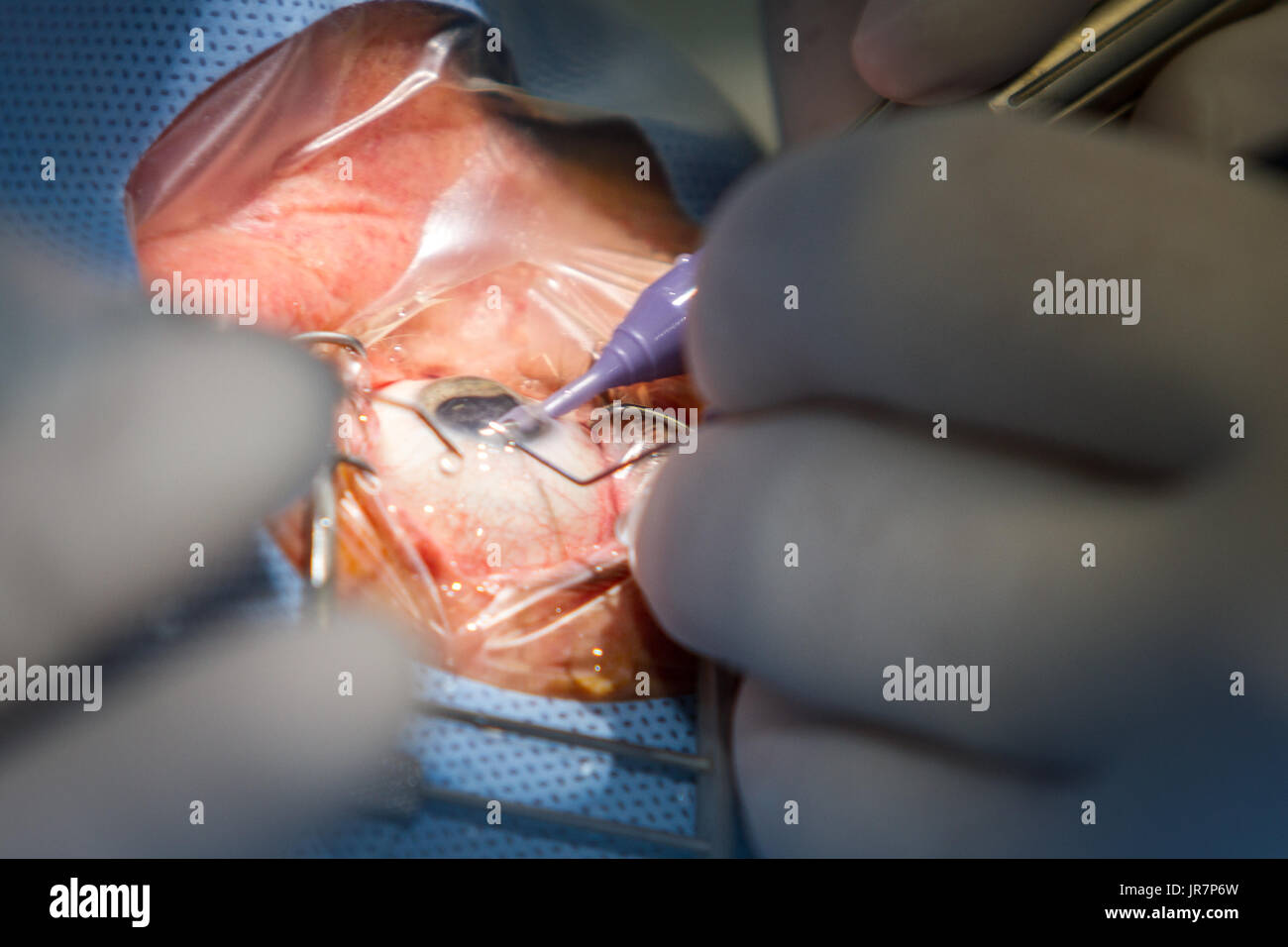 Zagreb, Croatia - June 12, 2017: Eye surgery in the hospital, eye and diopter correction. In the operation of the gray star, the torn lens is surgical Stock Photo