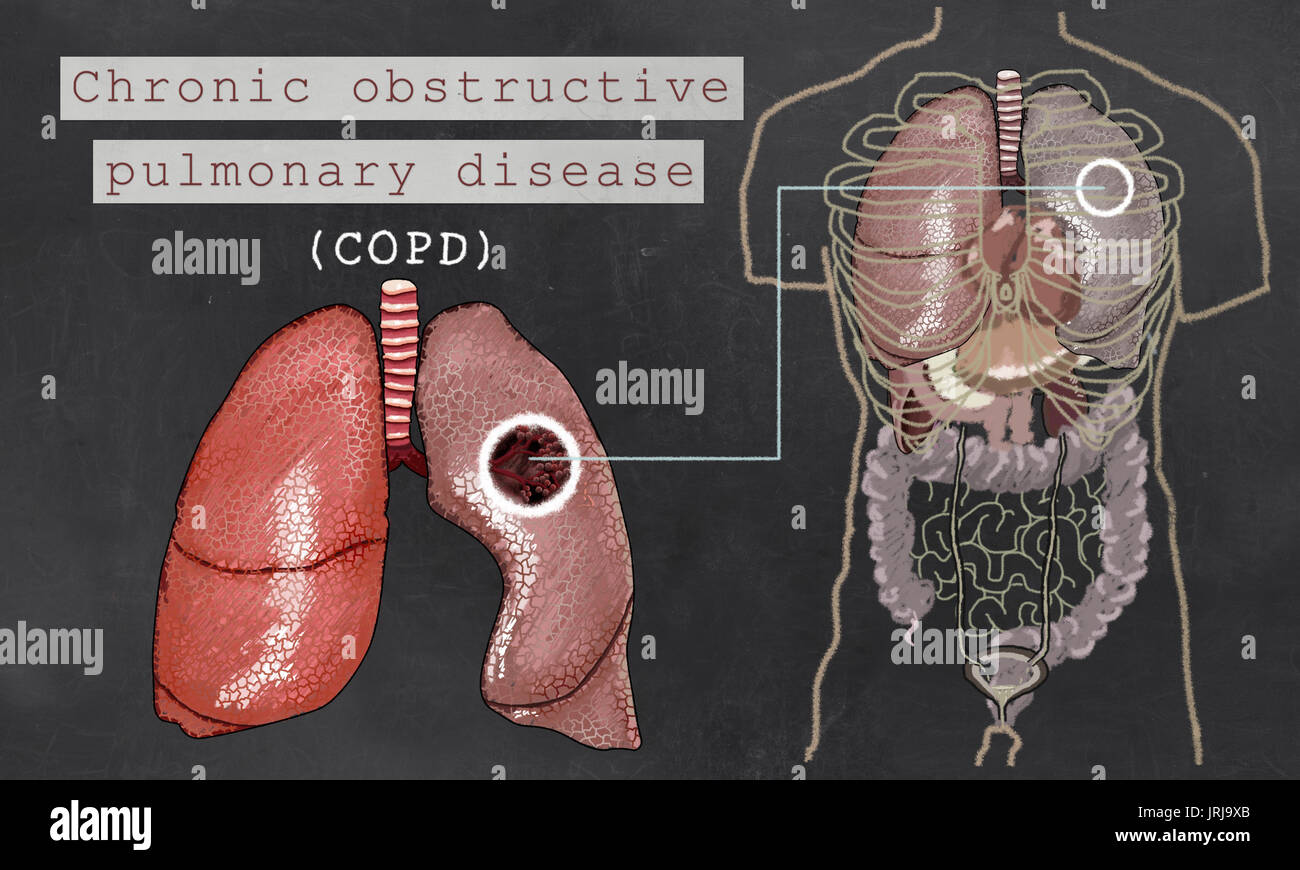 Congratulate, Adult disease lung Topic simply Adult disease lung