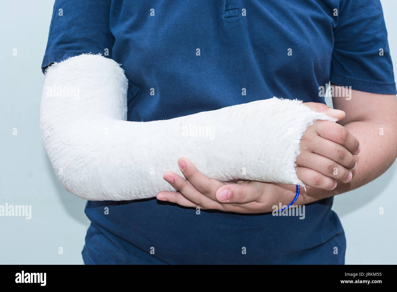 Boy with broken arm, plaster on arm as therapy. Close up of a young man's white long arm plaster / fiberglass cast covering the wrist, arm, and elbow  Stock Photo