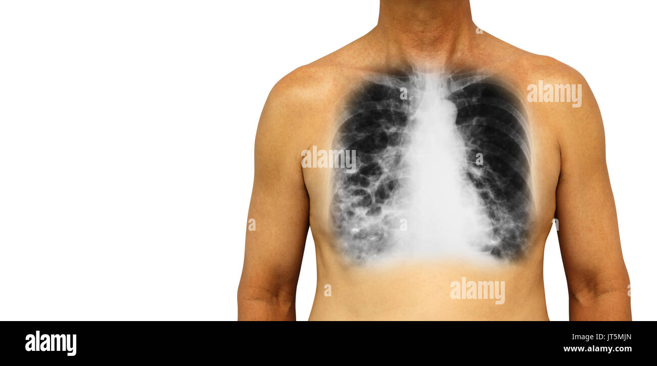 Bronchiectasis .  Human chest with x-ray chest show multiple lung bleb and cyst due to chronic infection . Isolated background . Blank area at Left si Stock Photo