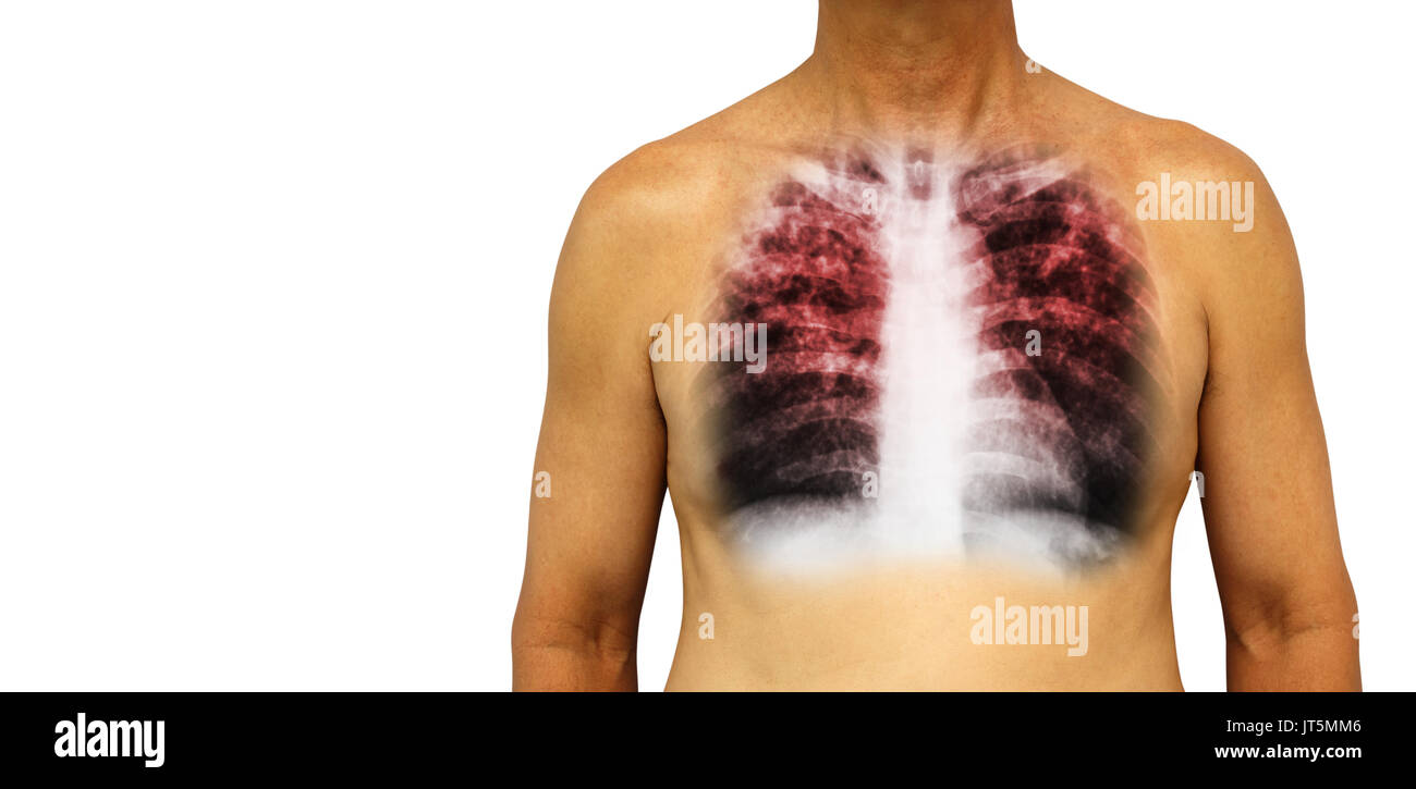 Pulmonary tuberculosis . Human chest with x-ray show interstitial infiltrate both lung due to infection . Isolated background . Blank area at Left sid Stock Photo