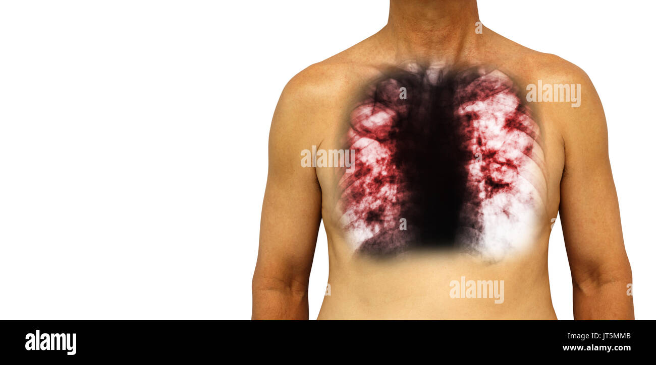Pulmonary tuberculosis . Human chest with x-ray show cavity at right lung and interstitial infiltrate both lung due to infection . Isolated background Stock Photo