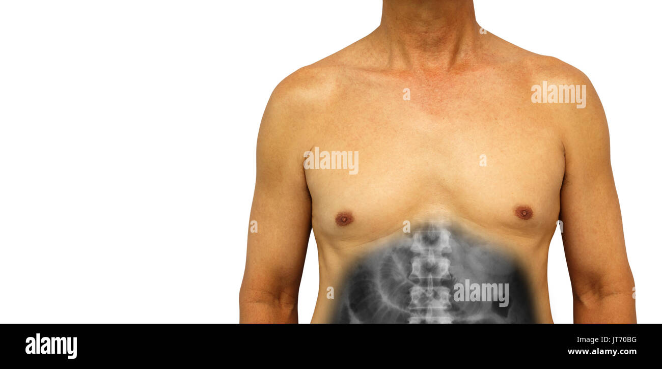 Colon cancer and Small intestine obstruction . Human abdomen with x-ray show small bowel dilated due to obstructed . Isolated background . Blank area  Stock Photo