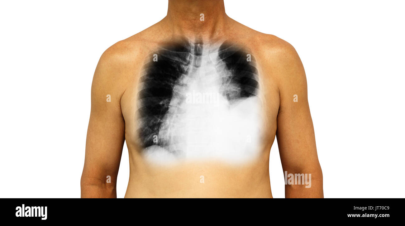 Lung cancer . Human chest and x-ray show pleural effusion left lung due to lung cancer . Stock Photo