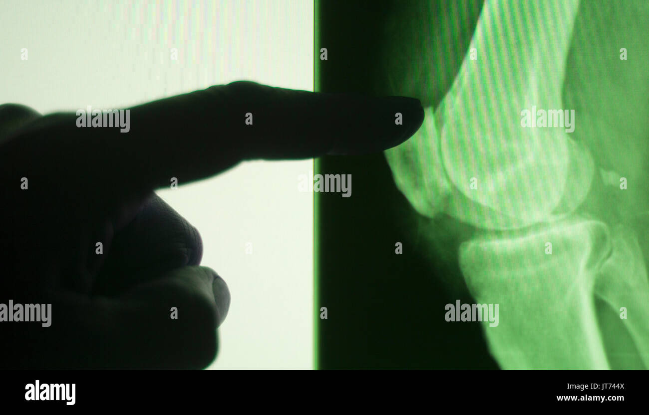 Knee joint xray test scan results of patient with arthritis and joints