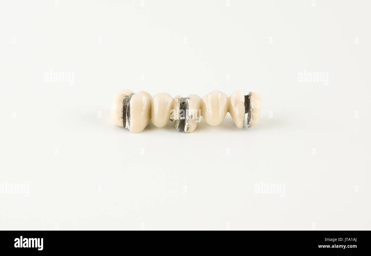 Denture damage from ceramic mass on a white background Stock Photo