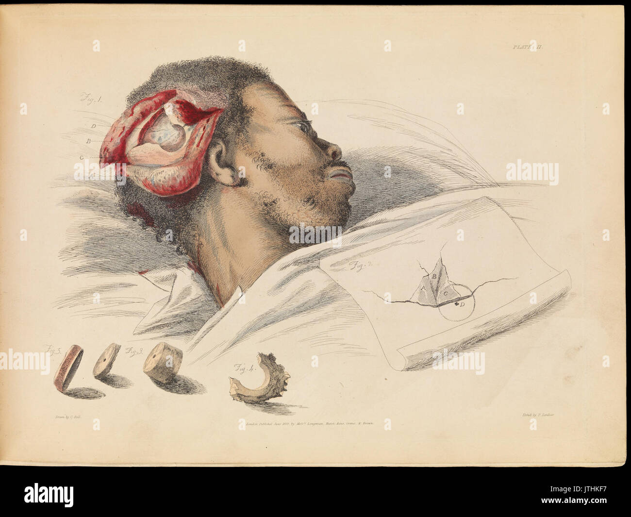 Plate II, illustration of trephination. Sir Charles Bell Wellcome L0072191 Stock Photo