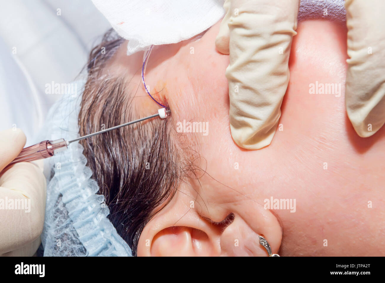 Dermatologist surgeon inserts polylactic acid filaments to perform facial lifting - Selective focus Stock Photo