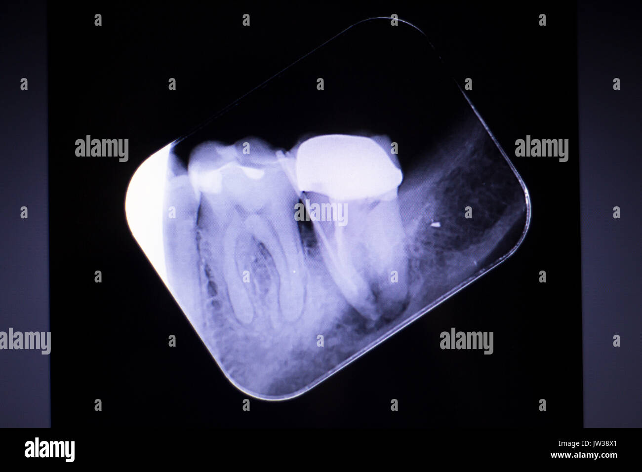 Dental xray test scan of tooth with crown filling and root canal