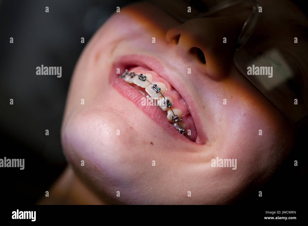 Teenage girl after having her brace fitted at the orthodontist Stock Photo