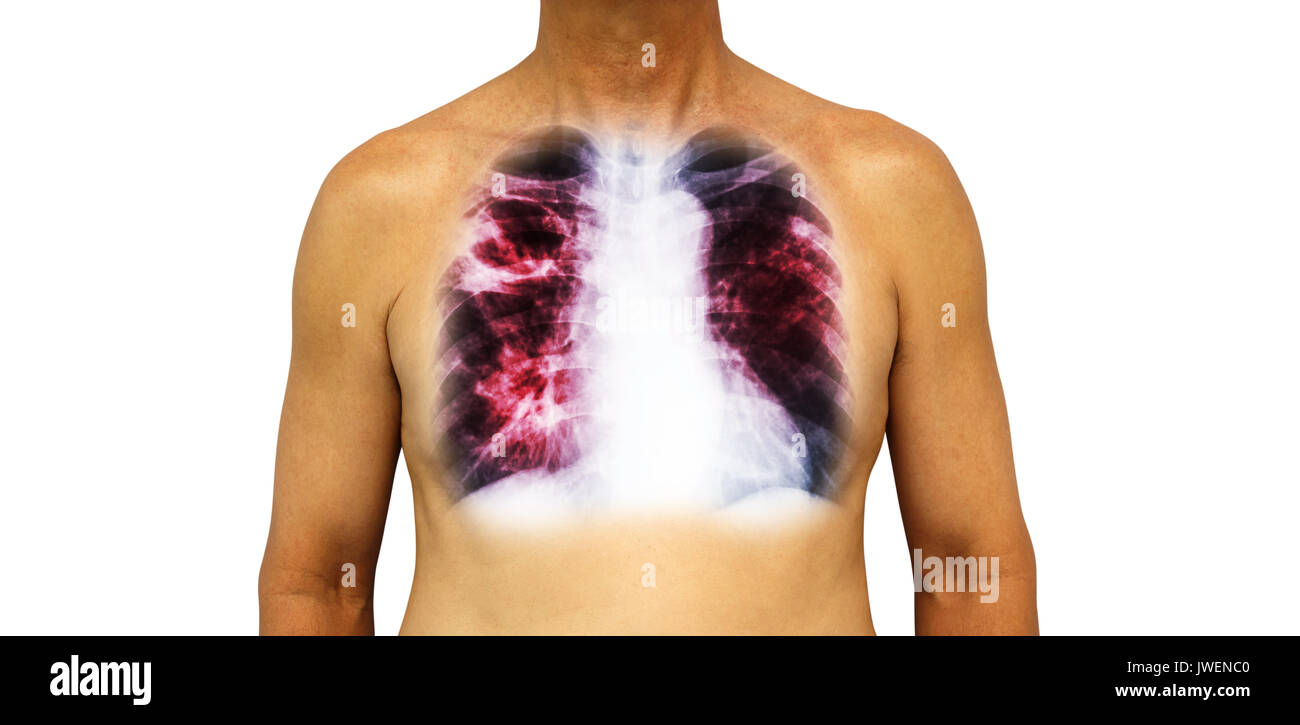 Pulmonary tuberculosis . Human chest with x-ray show cavity at right upper lung and interstitial infiltrate both lung due to infection . Isolated back Stock Photo