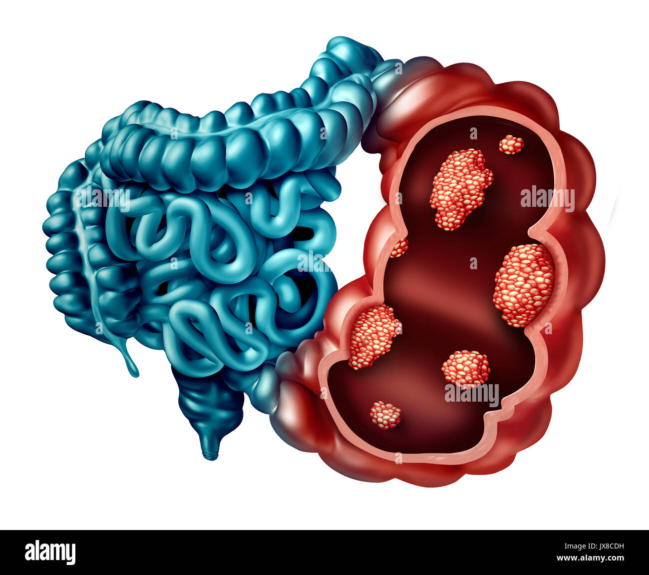 Colon cancer concept as a human intestine disease with forced perspective with microscopic malignant tumor inside the human anatomy. Stock Photo