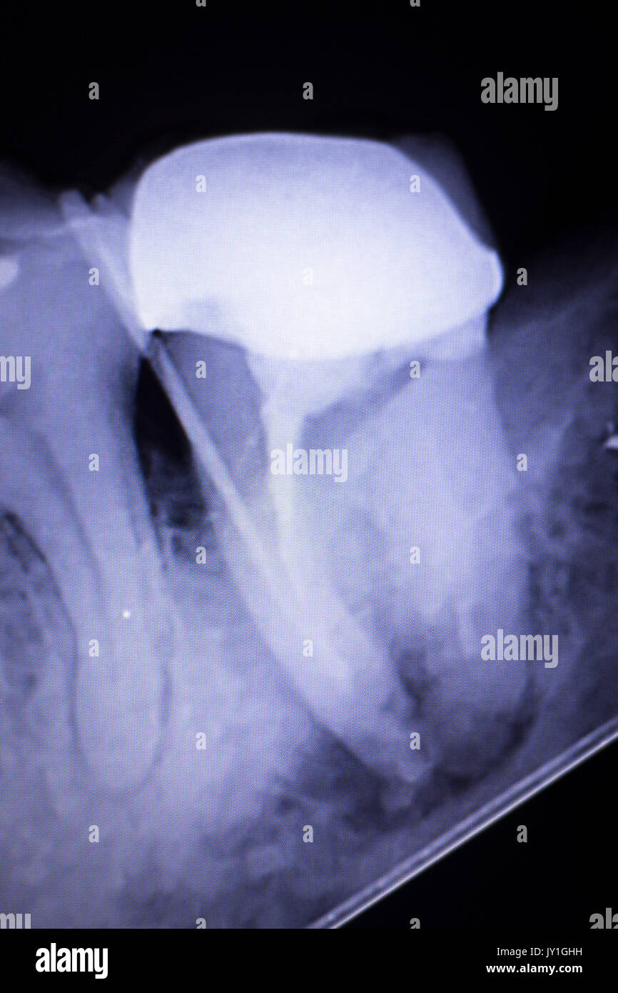 Dental xray test scan of tooth with crown filling and root canal