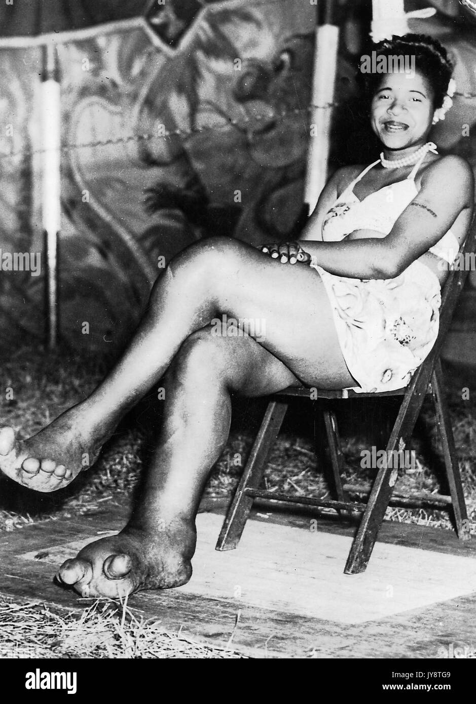 African American sideshow circus entertainer Sylvia Portis, known as Sylvia the Elephant Girl, smiling and displaying her feet, which are deformed and show signs of the disease elephantiasis, 1944. Stock Photo