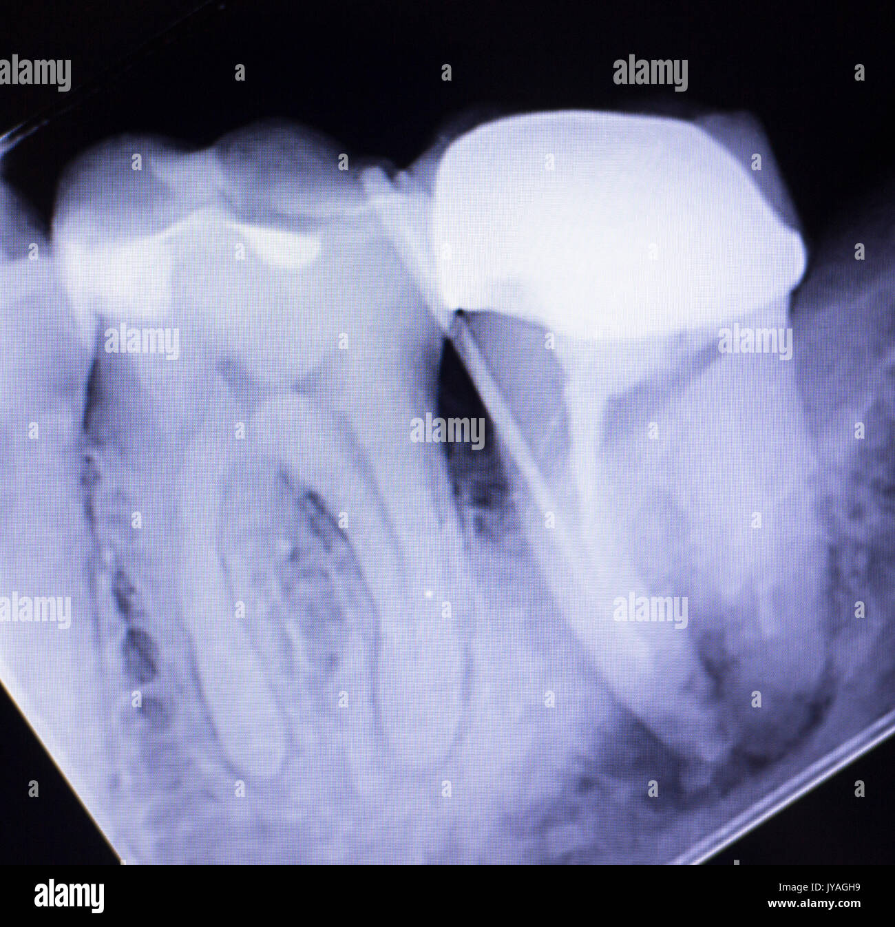 Dental xray test scan of tooth with crown filling and root canal