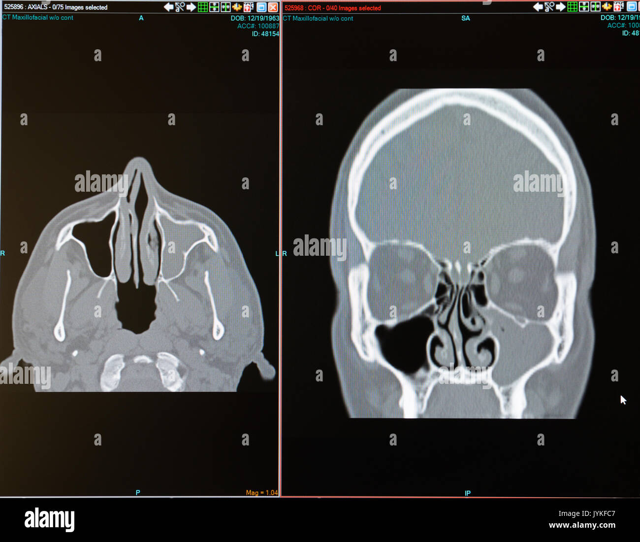 CT scan of male with sinus infection (sinusitis) filling the left maxillary sinus. Also reveals deviated septum Stock Photo