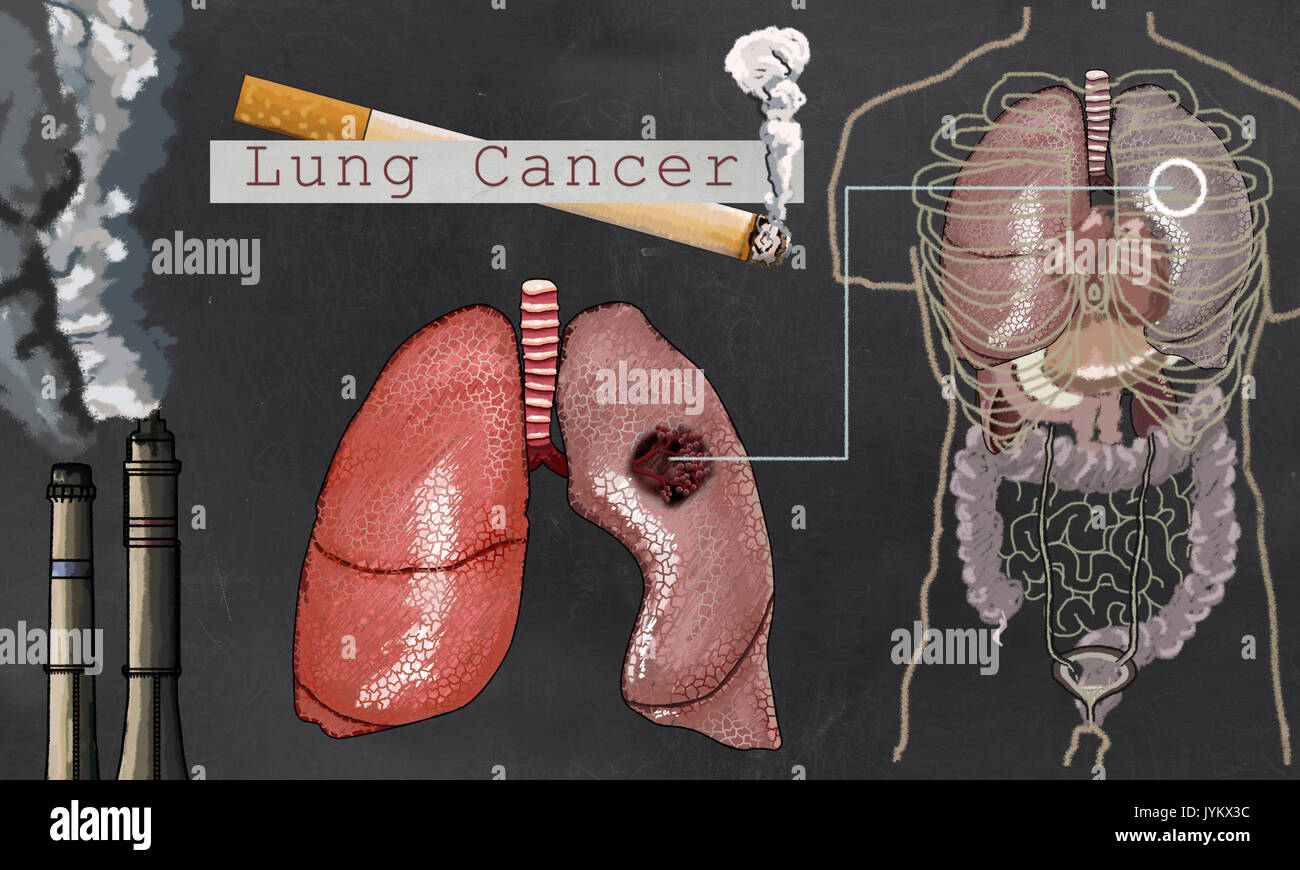 Illustration about Lung Cancer with Cigarette and Torso on Blackboard