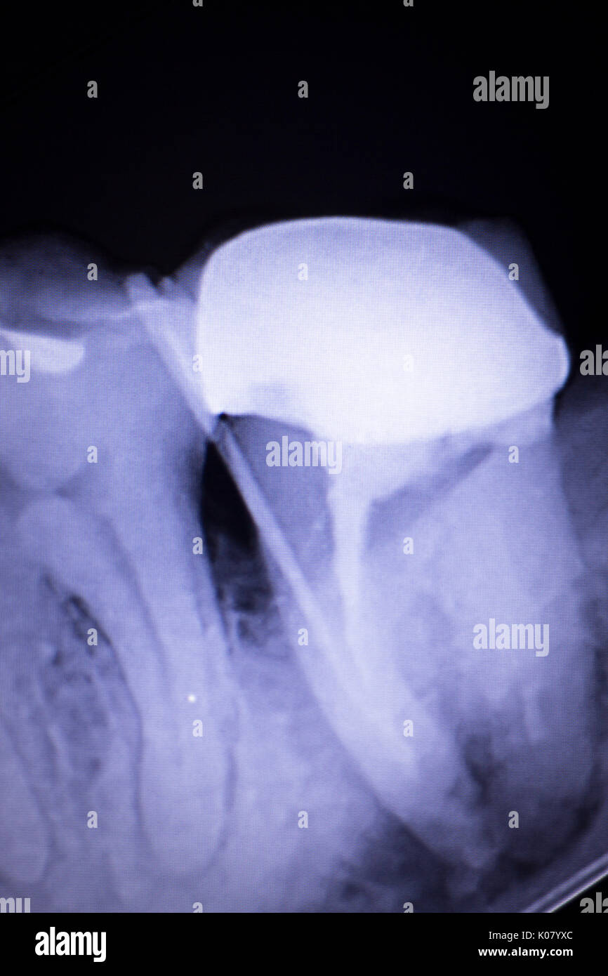 Dental xray test scan of tooth with crown filling and root canal