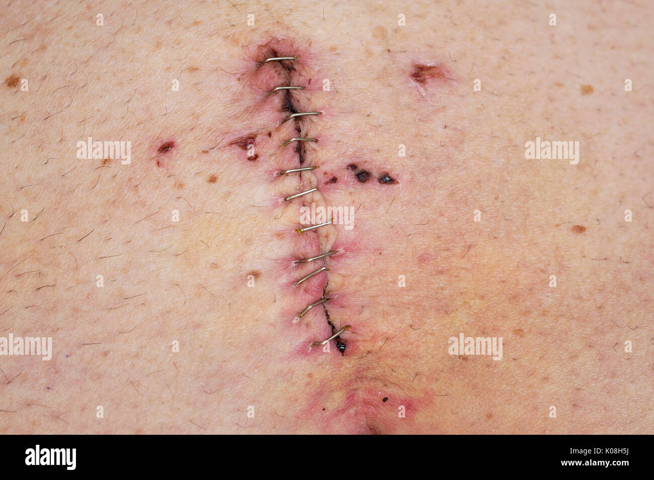 Medical stitches hi-res stock photography and images - Alamy