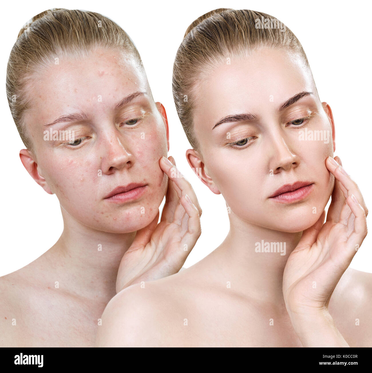 Woman with problem skin. Stock Photo