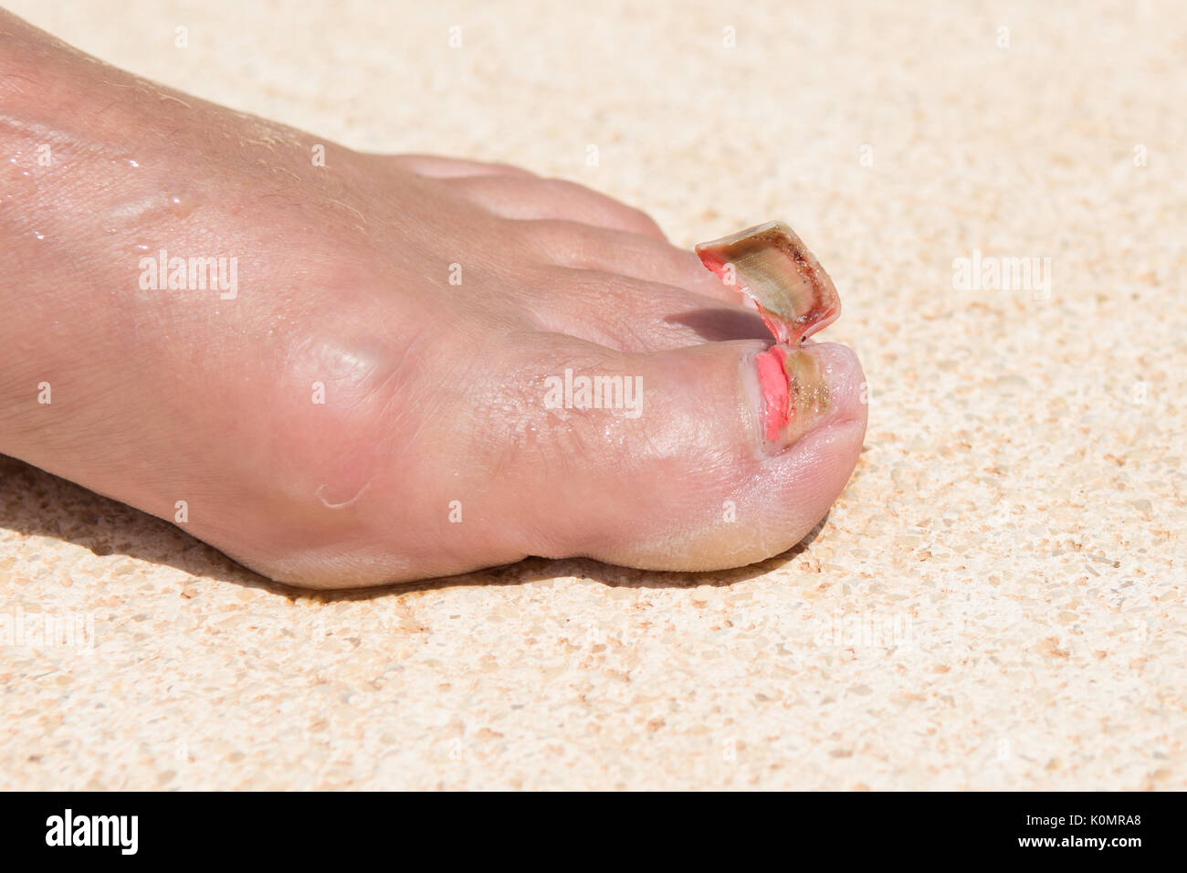 detached toenail Stock Photo