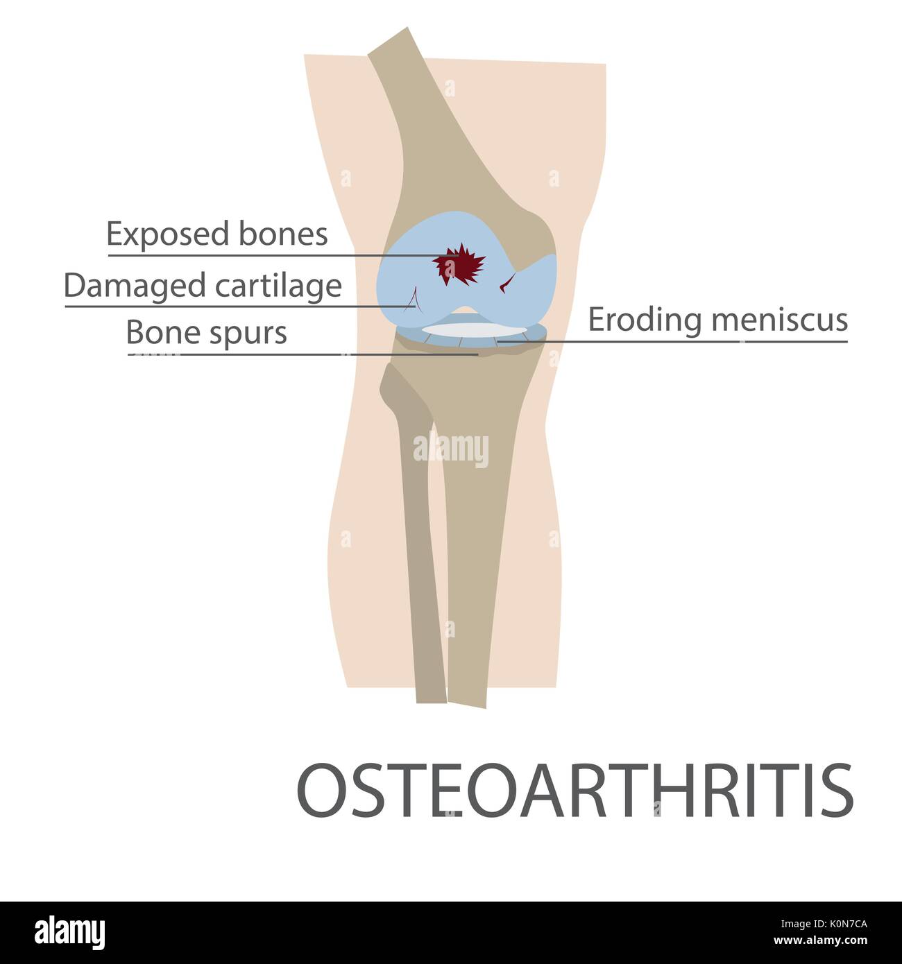 osteoarthritis human knee joint disease. vector format illustration Stock Vector