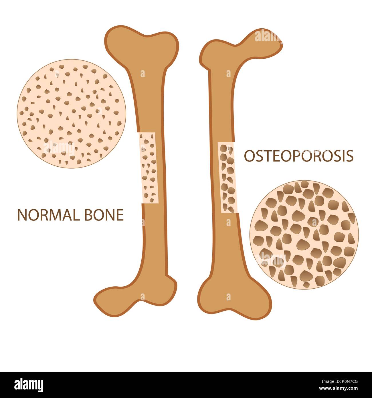 osteoporosis bone anatomy versus normal health bone. vector format illustration Stock Vector