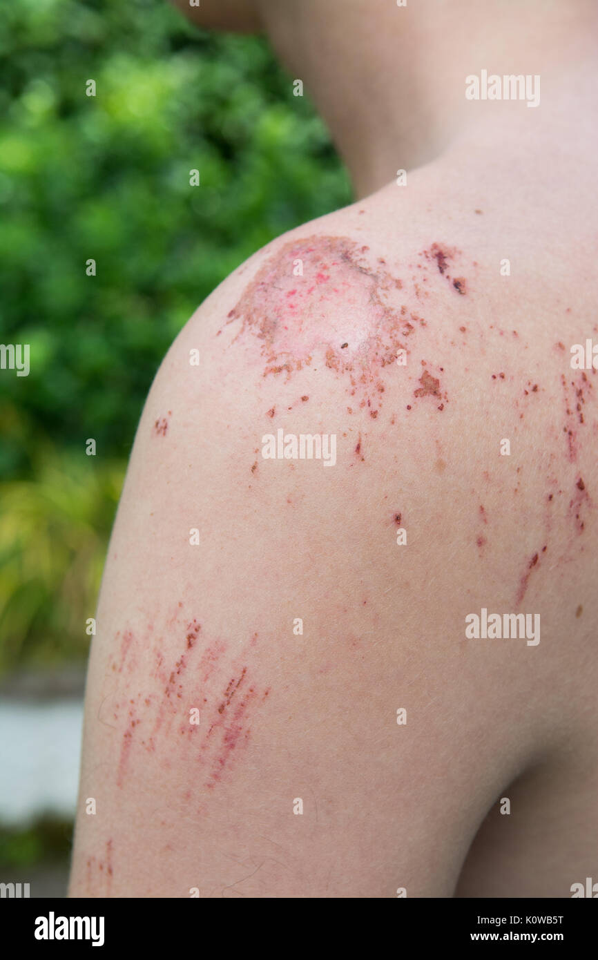 cuts and grazes to shoulder - downhill mountain biking injury to young man Stock Photo