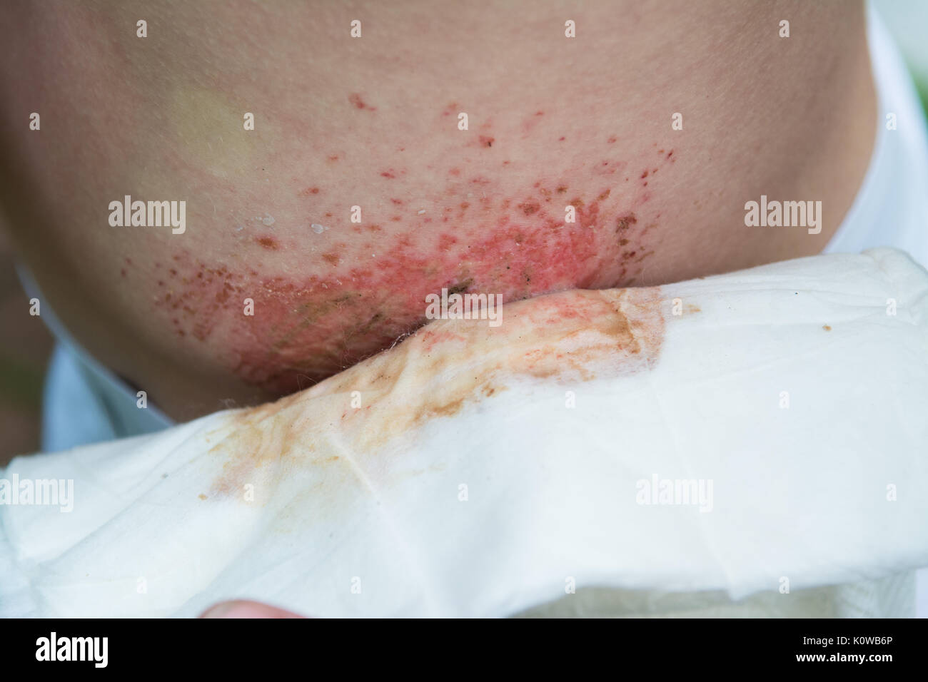 removing dressing from wound graze on side of body - downhill mountain biking injury to young man Stock Photo