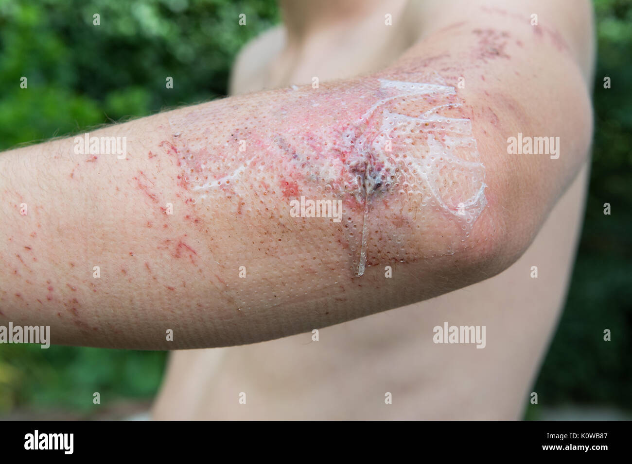 wound treated with skin glue and grazes to elbow covered with transparent film dressing - downhill mountain biking injury when not wearing elbow pads Stock Photo