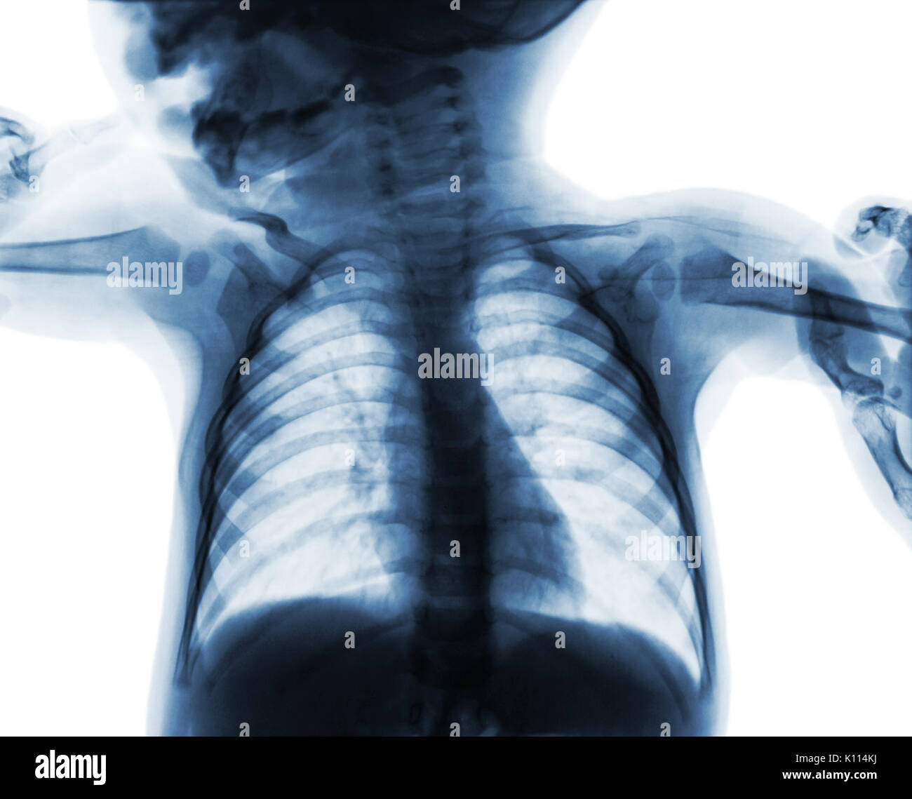 Film chest xray of child . isolated background Stock Photo Alamy