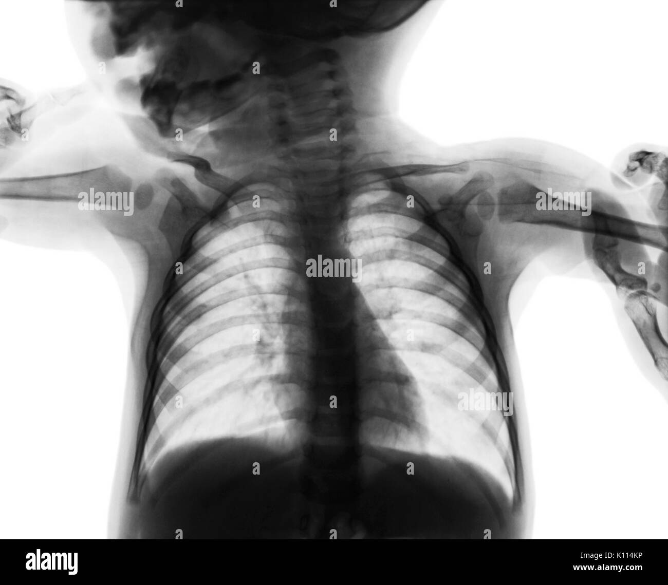 Film chest xray of child . isolated background Stock Photo Alamy
