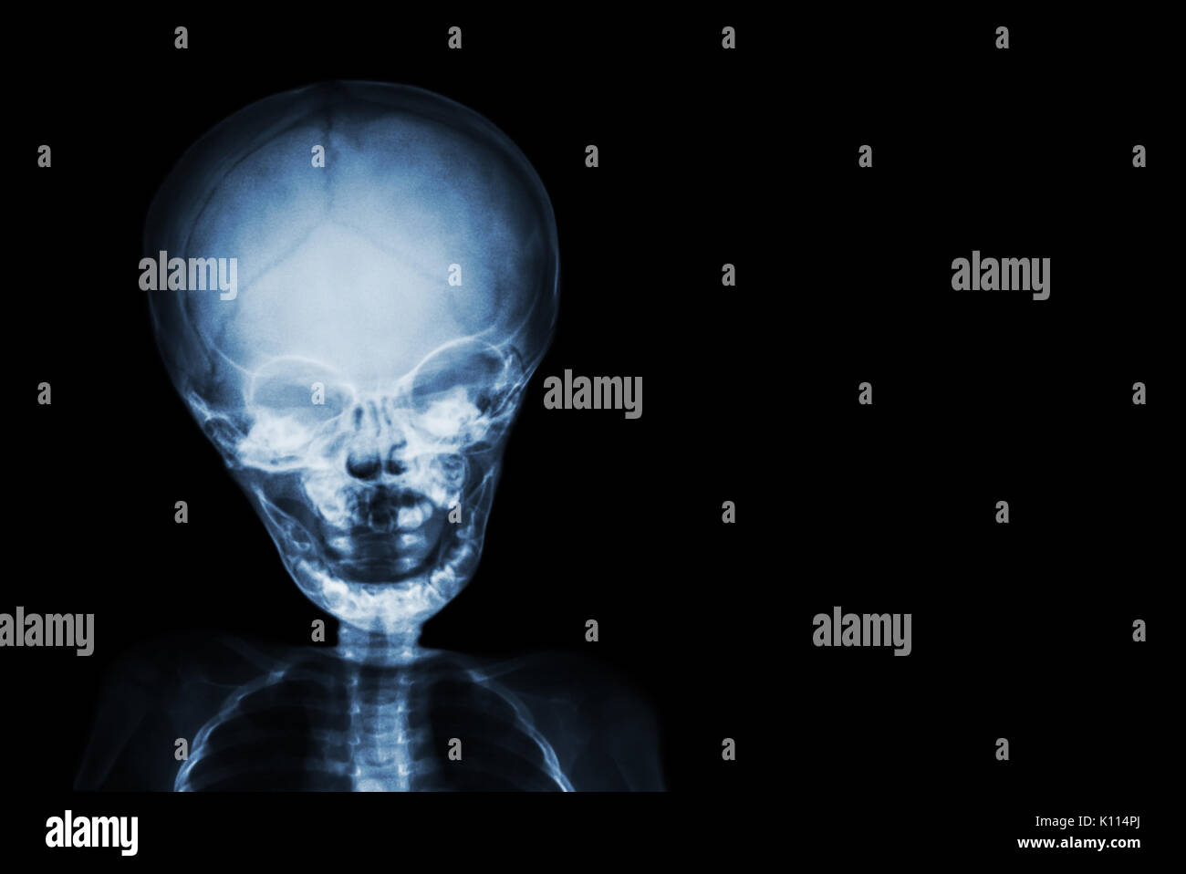 Film x-ray skull and body of child and blank area at right side . Stock Photo