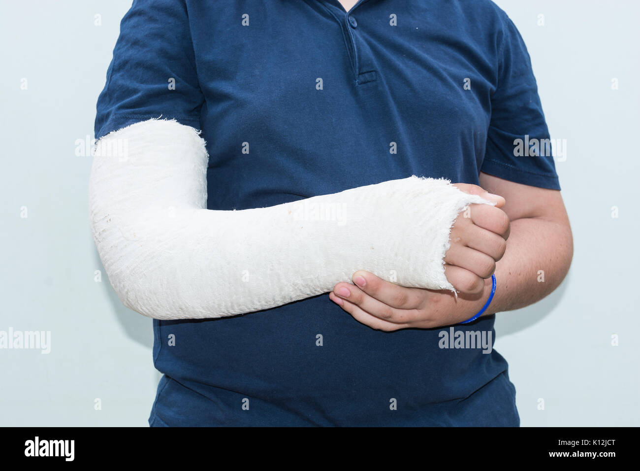 Boy with broken arm, plaster on arm as therapy. Close up of a young man's  white long arm plaster / fiberglass cast covering the wrist, arm, and elbow  Stock Photo - Alamy