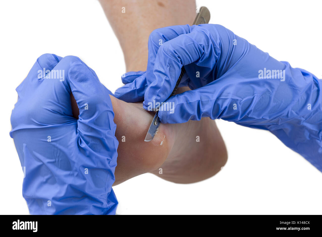 Woman receiving podiatry treatment- podiatrist chiropodist cleaning womans feet Stock Photo