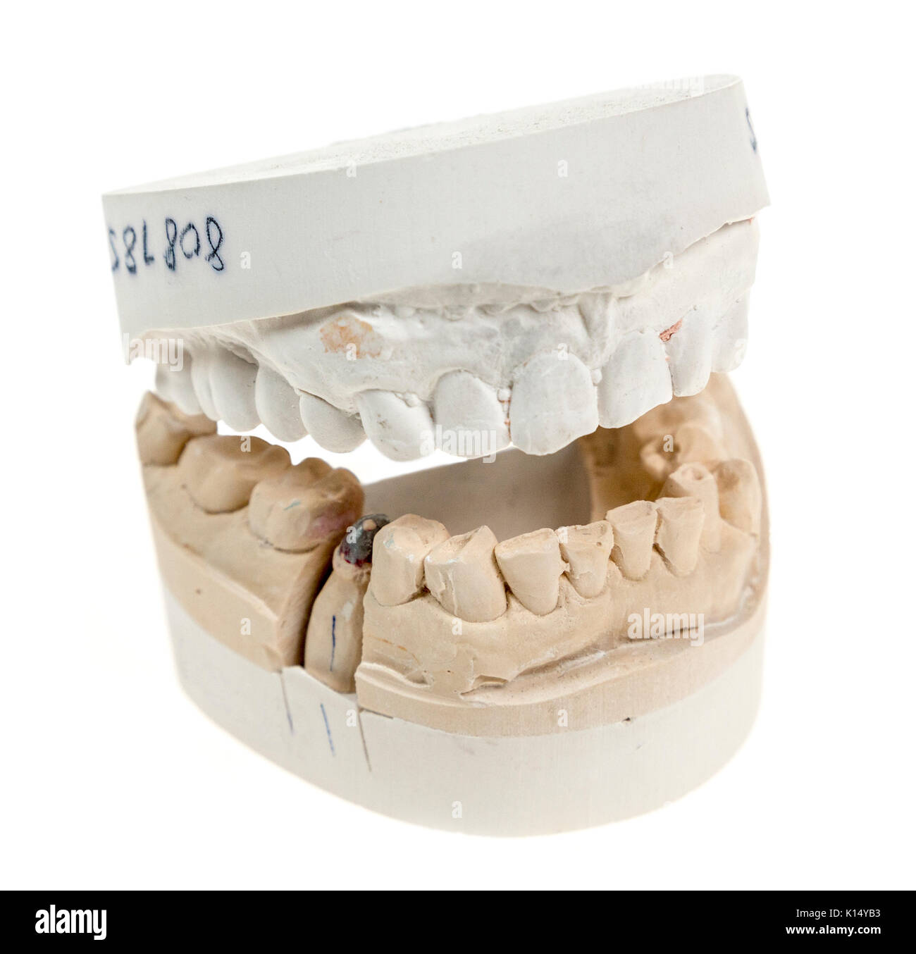 Dental procedure plaster cast mould of mouth and teeth as used to prepare a crown implant Stock Photo