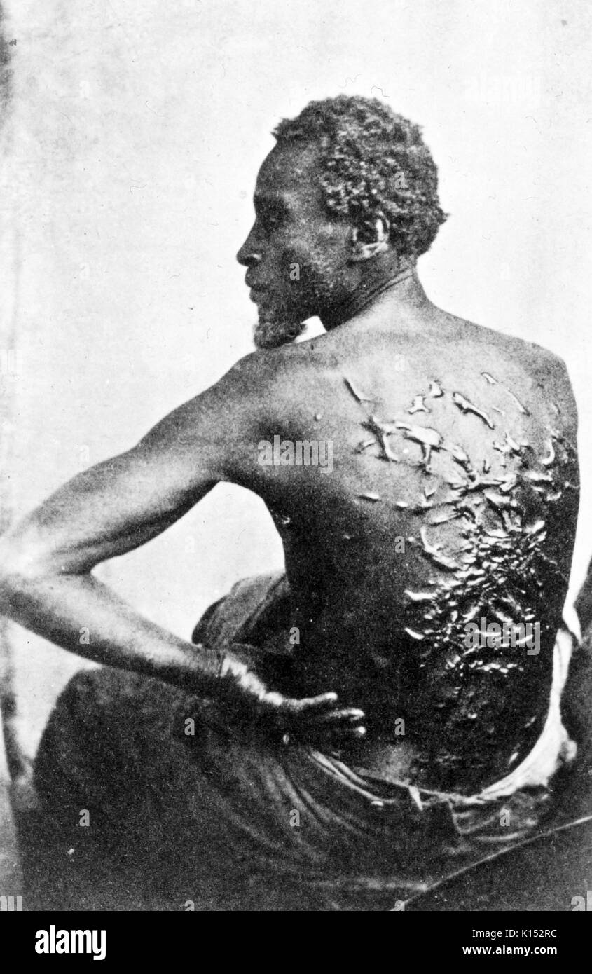 The Scourged Back - The furrowed and scarred back of Gordon, a slave who escaped from his master in Mississippi and made his way to a Union Army encampment in Baton Rouge, Louisiana during the American Civil War, 1863. Stock Photo