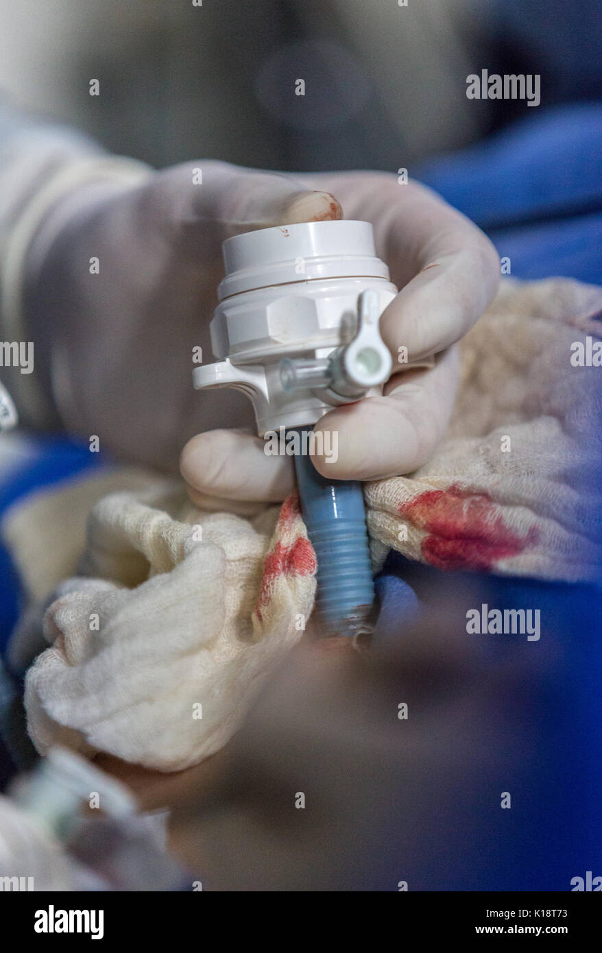 Closeup of catheter during free surgery performed by CiinterAndes at
