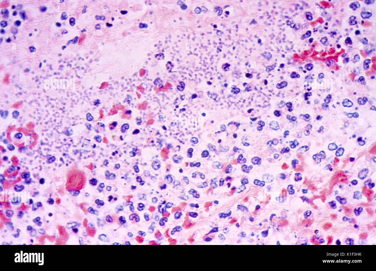 Photomicrograph of Giemsa stained lung tissue from a patient with fatal human plague, revealing pneumonia, and an abundance of Y. pestis organisms. Image courtesy CDC. 1990. Stock Photo