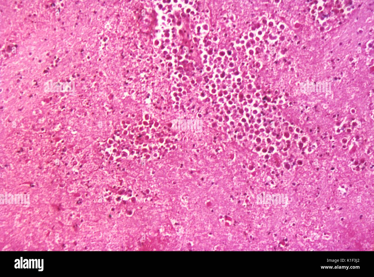 Primary amebic meningoencephalitis hires stock photography and images