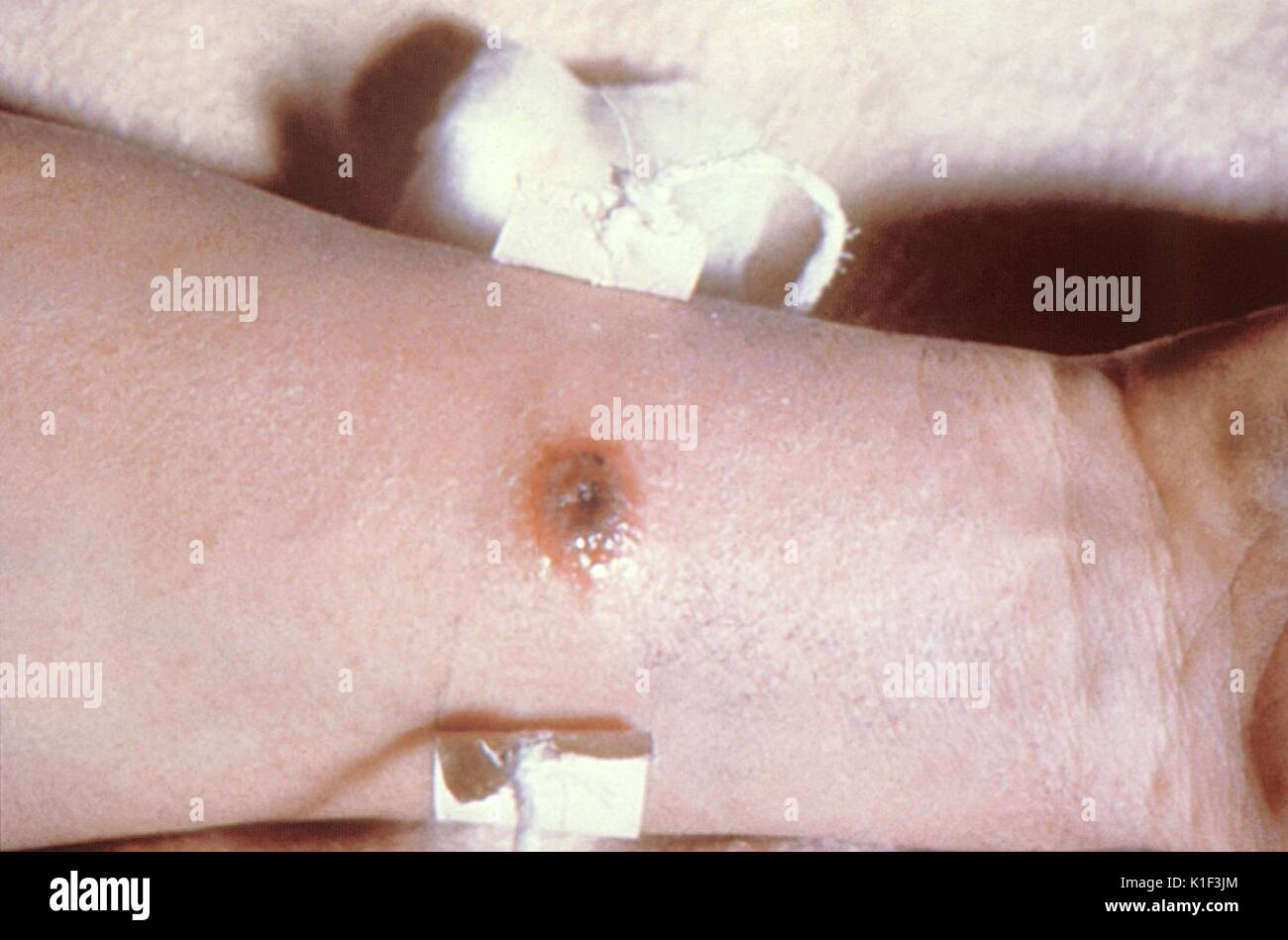 Anthrax lesion on volar surface of right forearm. Cutaneous anthrax lesion on the volar surface of the right forearm. Image courtesy CDC. 1990. Stock Photo