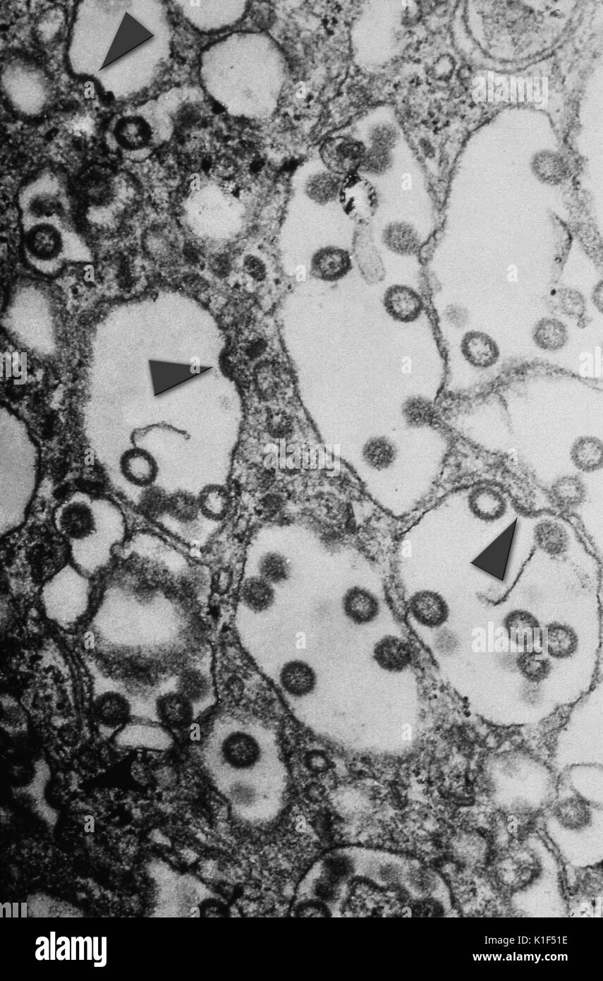 Under a very high magnification, this transmission electron micrograph (TEM) revealed some of the ultrastructural morphology seen in an unknown tissue sample, which had been caused by the spherical-shaped, enveloped Rift Valley fever (RVF) virus. In this particular view you can see some virions budding from the cell membrane, indicated by arrowheads. Rift Valley fever (RVF) is an acute, fever-causing viral disease most commonly observed in domesticated animals (such as cattle, buffalo, sheep, goats, and camels), with the ability to infect and cause illness in humans. The disease is caused by R Stock Photo