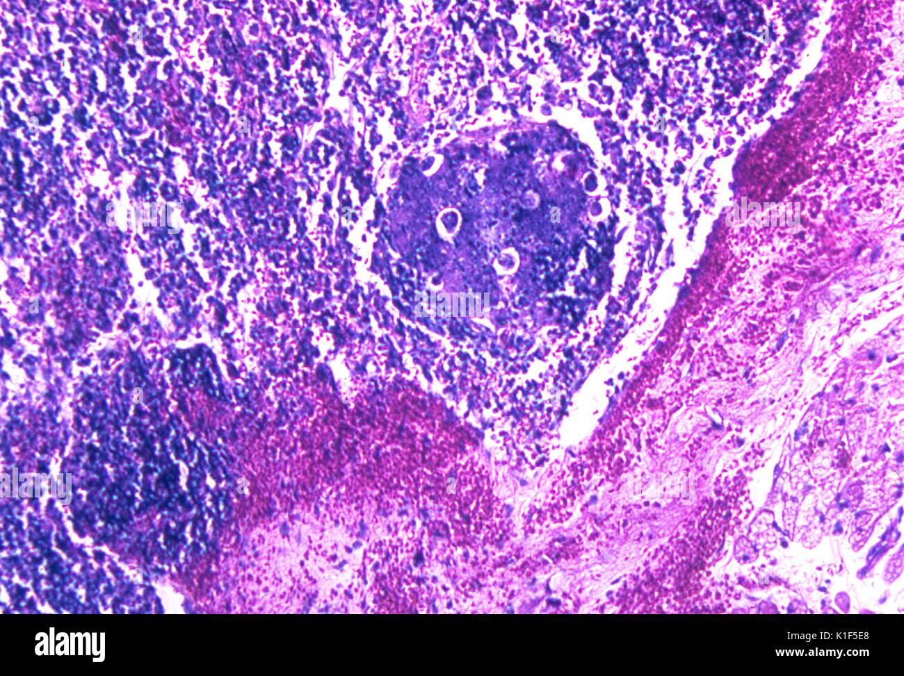 Hemorrhagic lymph node due to inhalation anthrax. Photomicrograph of mediastinal lymph node from a Cynomolgus monkey, ( Macaca fascicularis ). Moderate hemorrhage, necrosis, and edema are present. Giemsa stain, Mag. 125x. Image courtesy CDC/Dr. Ken Roberts, 1971. Stock Photo