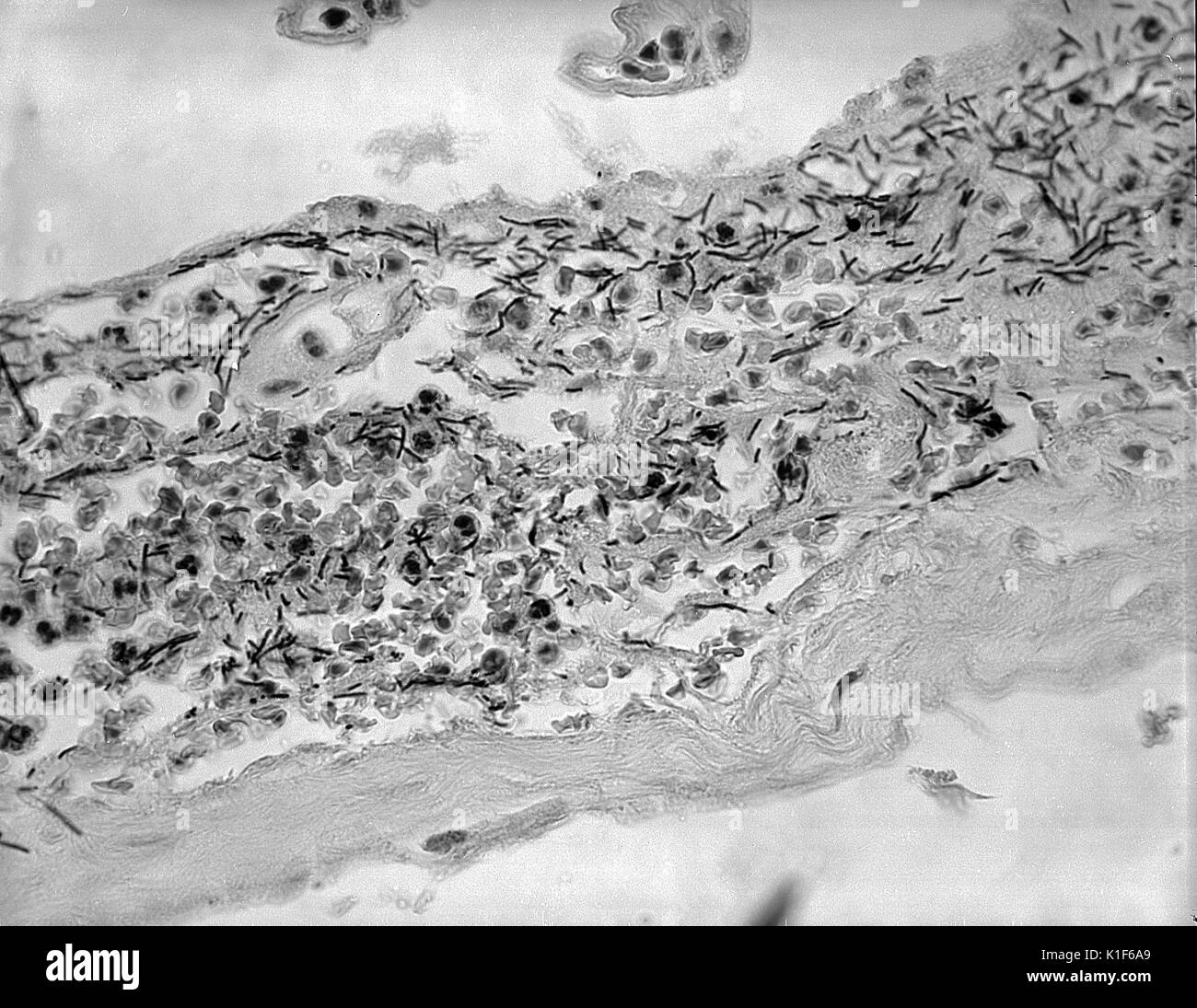 Photomicrograph of meninges demonstrating the presence of Bacillus anthracis in a case of fatal inhalation anthrax. Image courtesy CDC/Dr. LaForce, 1967. Stock Photo