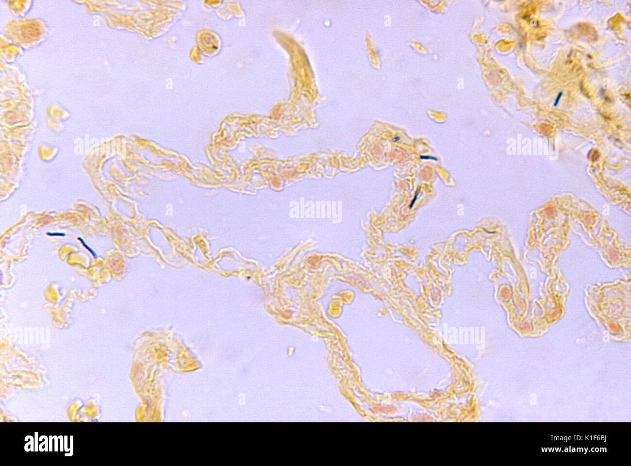Bacillus anthracis in lung. Photomicrograph of Bacillus anthracis in lung tissue in a case of fatal inhalation anthrax, BandB stain, Mag. 500x. Image courtesy CDC/Dr. LaForce, 1967. Stock Photo