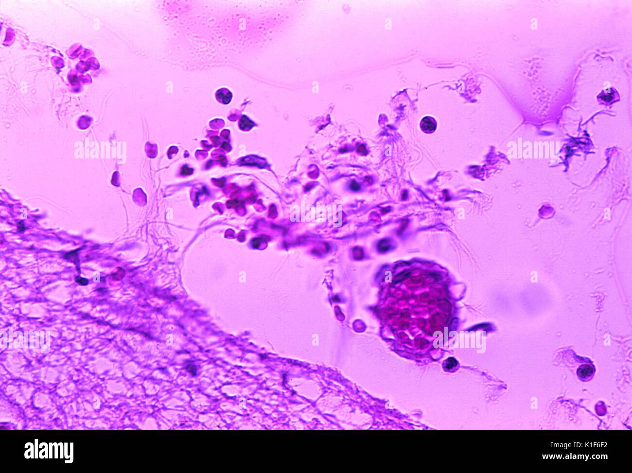 Mild meningitis with hemorrhage due to Bacillus anthracis . Photomicrograph of mild meningitis along with hemorrhage, and the presence of Bacillus anthracis in a case of fatal human anthrax. Image courtesy CDC/Dr. Marshall Fox, 1976. Stock Photo